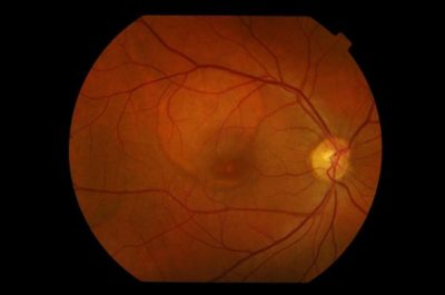 Central Serous Retinopathy | Alliance Retina Consultants