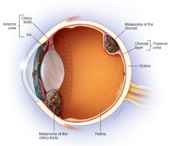 Ocular Tumors Alliance Retina Consultants